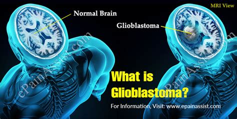 What is Glioblastoma| Symptoms|Treatment|Life Expectancy ...