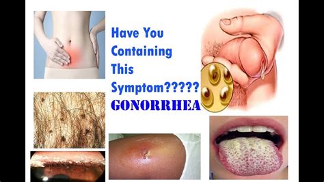 What is Gonorrhea |Symptoms| Cause| STD   YouTube