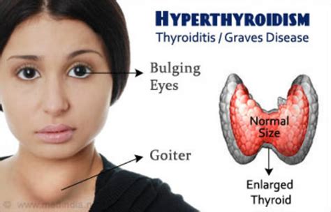 What Is Hyperthyroidism, The Symptoms And Diet To Use ...