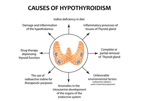 What Is Hypothyroidism, and Is it Treatable? | HealthProAdvice