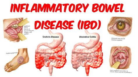 What is Inflammatory Bowel Disease  IBD  | Health Life Media