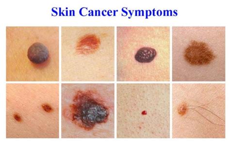 What is Skin Cancer? Causes, Skin Cancer Symptoms and Risk ...