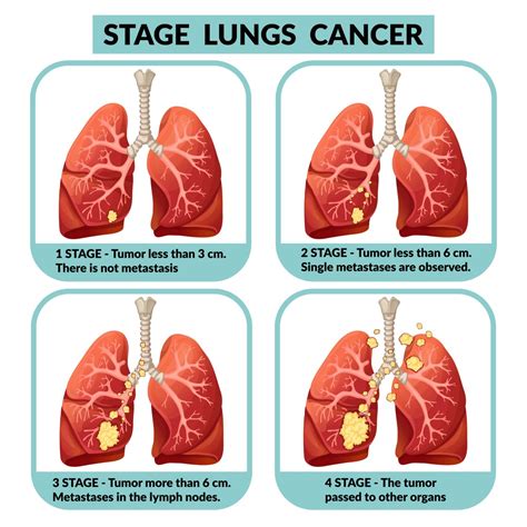 What Is The Best Treatment For Lung Cancer Stage 4? | by ...