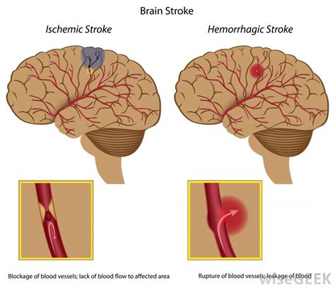 What is the Difference Between an Ischemic Stroke and a ...