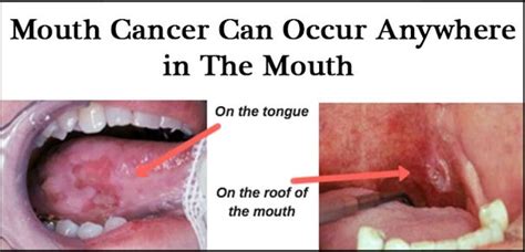 What is the early stage mouth cancer symptoms?   Quora