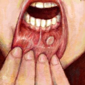 What Mouth Cancer Looks Like: Images of Oral Cancer