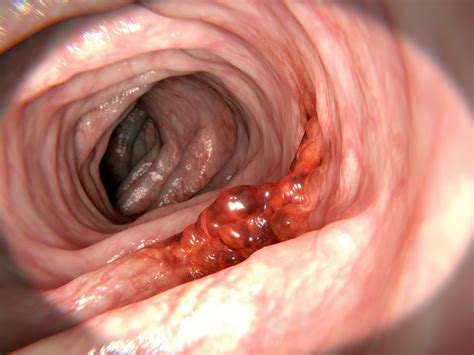 What You Can Do to Catch Colon Cancer Early – Health ...