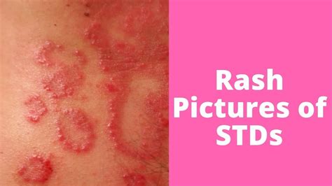 What’s This Rash Pictures of STDs   YouTube