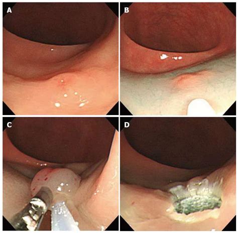 Which endoscopic treatment is the best for small rectal ...