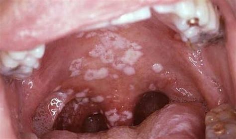 White Patches in Mouth, Back of Throat, Pictures, Causes ...