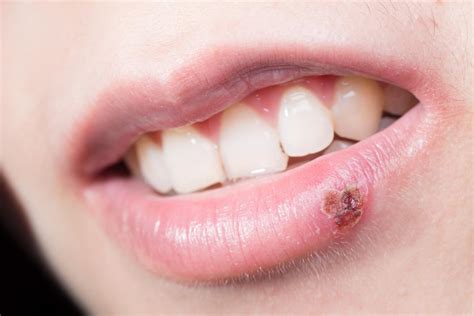 Why do I keep getting cold sores? Causes and prevention