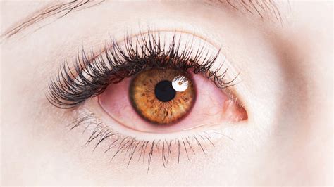 Why Eyes Are Red and How To Get Rid of Bloodshot Eyes   Health