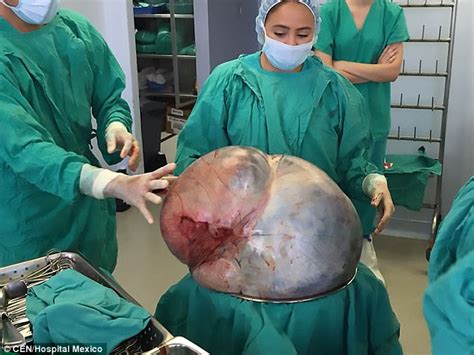 Woman had a five stone tumour removed from her ovaries ...