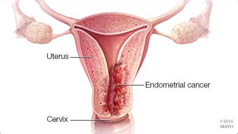 Women’s Wellness: Endometrial cancer — risk factors ...