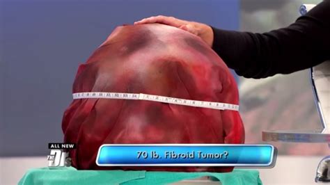 World’s Largest Fibroid Tumor!   YouTube